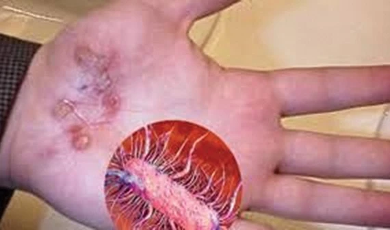 Điều trị thành công ca bệnh Whitmore tại Thái Nguyên