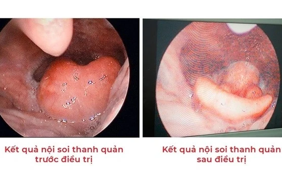 Người phụ nữ phù nề thanh quản do ngậm vitamin C sủi trị hóc xương cá