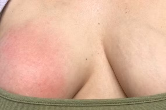 Ngực cô gái có nguy cơ nổ tung, bác sĩ gấp rút hút ra hơn 1 lít dịch