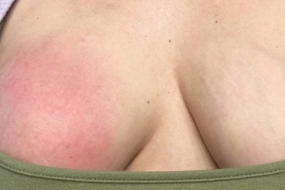 Ngực cô gái có nguy cơ nổ tung, bác sĩ gấp rút hút ra hơn 1 lít dịch