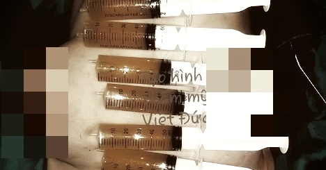 Ngực cô gái sắp “nổ tung”, bác sĩ tá hỏa hút dịch