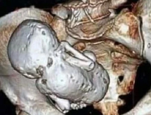 Thai nhi nằm trong bụng suốt 35 năm mà mẹ không hay biết