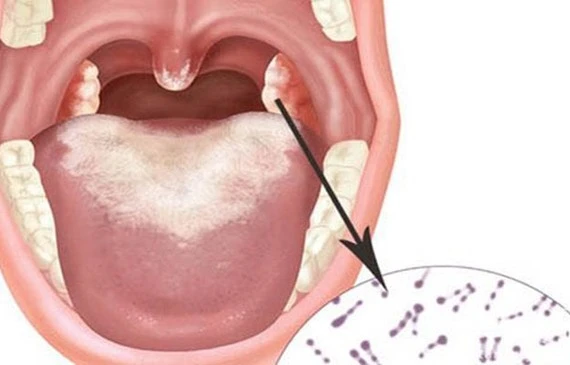 Cần làm gì khi tiếp xúc gần với bệnh nhân mắc bạch hầu?