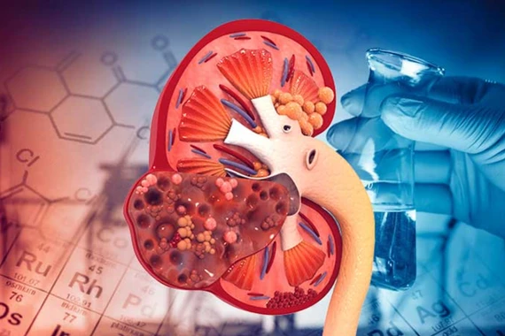 Thói quen xấu hàng ngày dễ dẫn đến suy thận