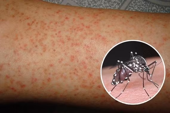 Thông tin cần biết về vắc xin phòng sốt xuất huyết