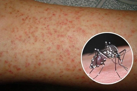 Thông tin cần biết về vắc xin phòng sốt xuất huyết