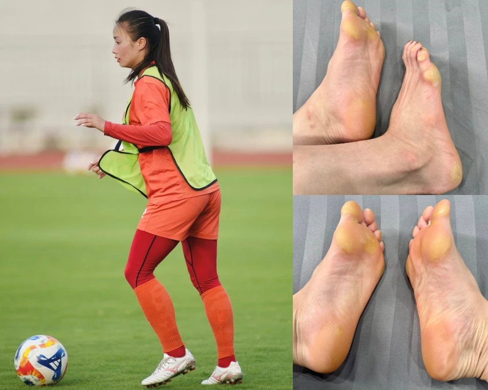 Hot girl bóng đá Hoàng Thị Loan gây xôn xao với bàn chân biến dạng