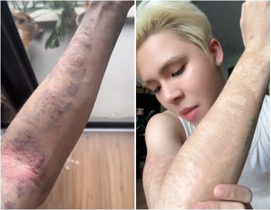 Chơi hình xăm dán, nam TikToker bị dị ứng nghiêm trọng