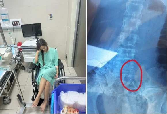 Đi ăn ốc, cô gái nuốt cả chiếc kim băng và tốn 70 triệu lấy dị vật