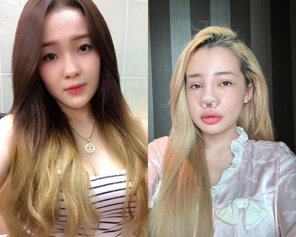 10 năm qua, Ngân 98 từng 'nghiện' phẫu thuật thẩm mỹ ra sao?