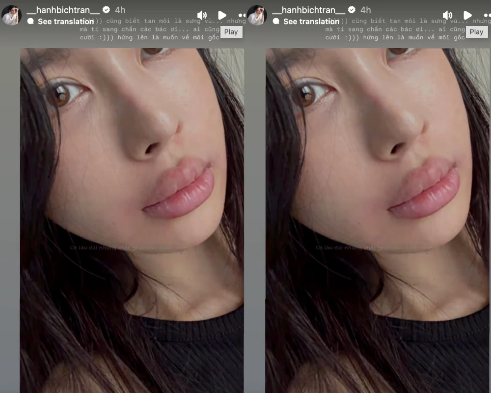 Bạn gái Vũ Văn Thanh xuất hiện với đôi môi sưng vù gây chú ý