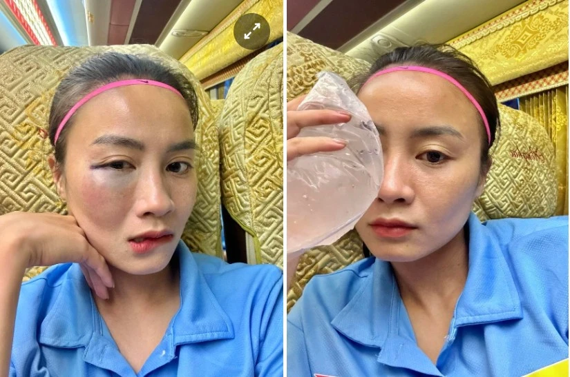Fan xót xa trước gương mặt sưng vù của hot girl bóng đá Hoàng Thị Loan