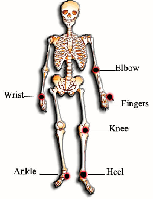 Viêm khớp dạng thấp là bệnh của người già? Đa số bệnh nhân viêm khớp dạng thấp là người già song điều này không đồng nghĩa với việc chỉ người già mới mắc bệnh. Nó là dạng bệnh tự miễn nên hoàn toàn có khả năng xuất hiện ở giới trẻ.