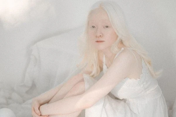 Người mẫu bạch tạng Việt, khoe nhan sắc khiến dân tình chết lịm