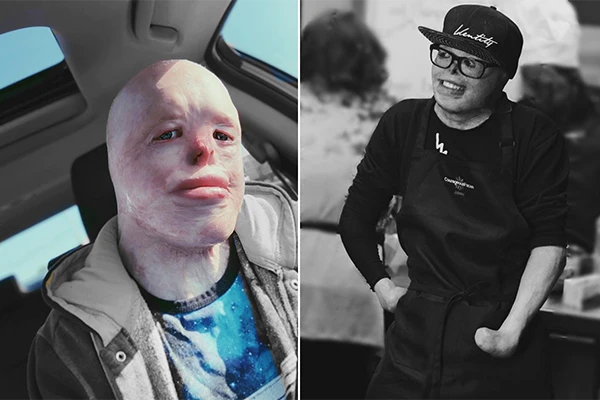 Bỏng 95% cơ thể, chàng trai từng coi mình là quái vật giờ ra sao?