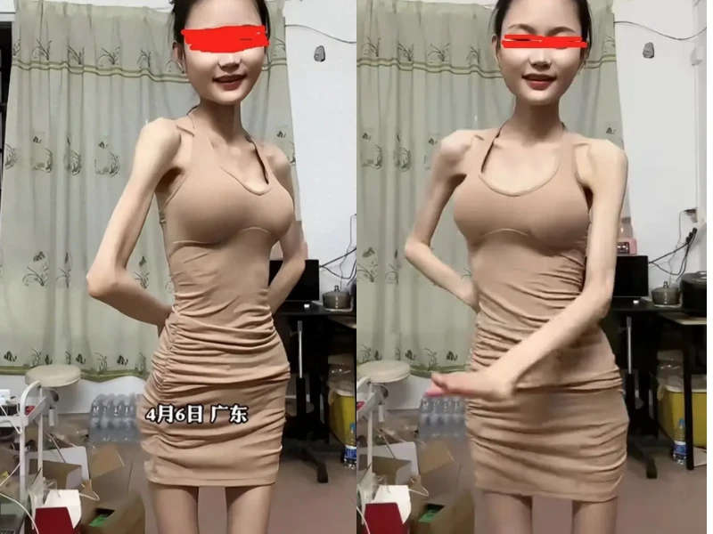 Hoảng hốt với cô gái thân hình mỏng tang vì giảm cân quá đà