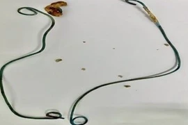 Cấp cứu người phụ nữ trẻ quên thiết bị y tế trong cơ thể do quá bận