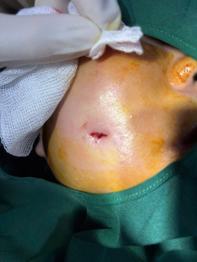 Bệnh nhân nữ bị biến chứng nhiễm trùng áp xe sau khi phẫu thuật tạo má lúm đồng tiền tại cơ sở làm đẹp không uy tín.