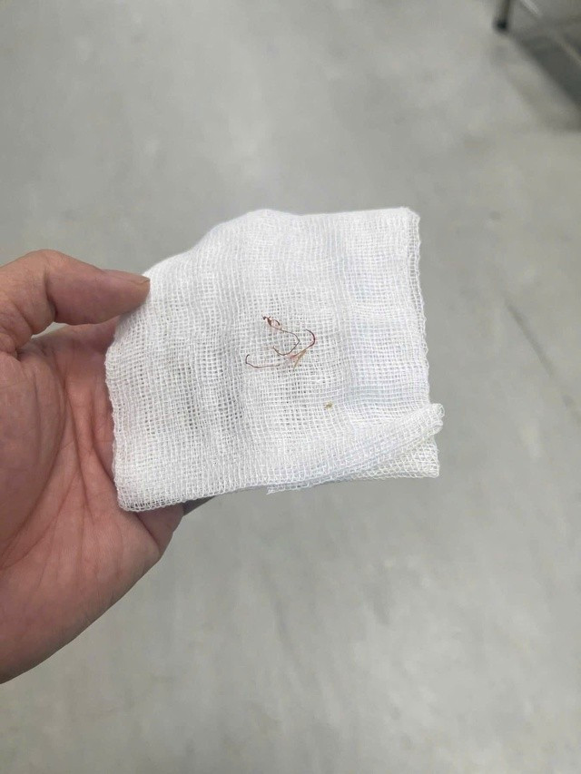 Sợi chỉ được gắp từ má bệnh nhân.