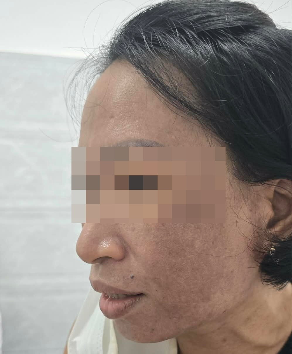 Bệnh nhân da bị sạm đen và giãn mạch sau khi sử dụng sản phẩm trôi nổi. Ảnh: BSCC.