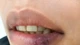  Tưởng khô môi, dị ứng đi khám mắc lupus ban đỏ dạng đĩa