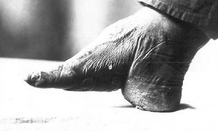 “Độc chiêu” làm đẹp cực đau đớn thời xưa 