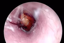 Gắp thành công côn trùng sống trong ống tai bệnh nhân ở Quảng Trị