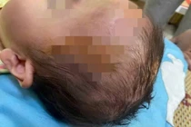 Bé gái 19 tháng tuổi bị chó cắn tổn thương nặng vùng mặt