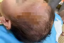 Bé gái 19 tháng tuổi bị chó cắn tổn thương nặng vùng mặt