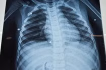 Bé trai bị đa chấn thương nghiêm trọng do nghịch súng hơi