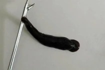 Gắp ra con đỉa sống ký sinh trong mũi bệnh nhi ở Quảng Trị