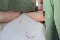 Gắp thành công dị vật nằm trong tầng sinh môn người phụ nữ suốt 11 năm