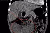 Phẫu thuật nội soi cắt lách xoắn cho bệnh nhi ở Quảng Trị