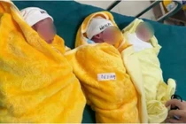 Mổ đẻ thành công ca sinh 3 tự nhiên hiếm gặp ở Quảng Trị