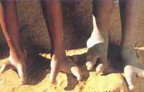 Sự thật ngỡ ngàng những bàn chân kỳ lạ nhất trên thế giới