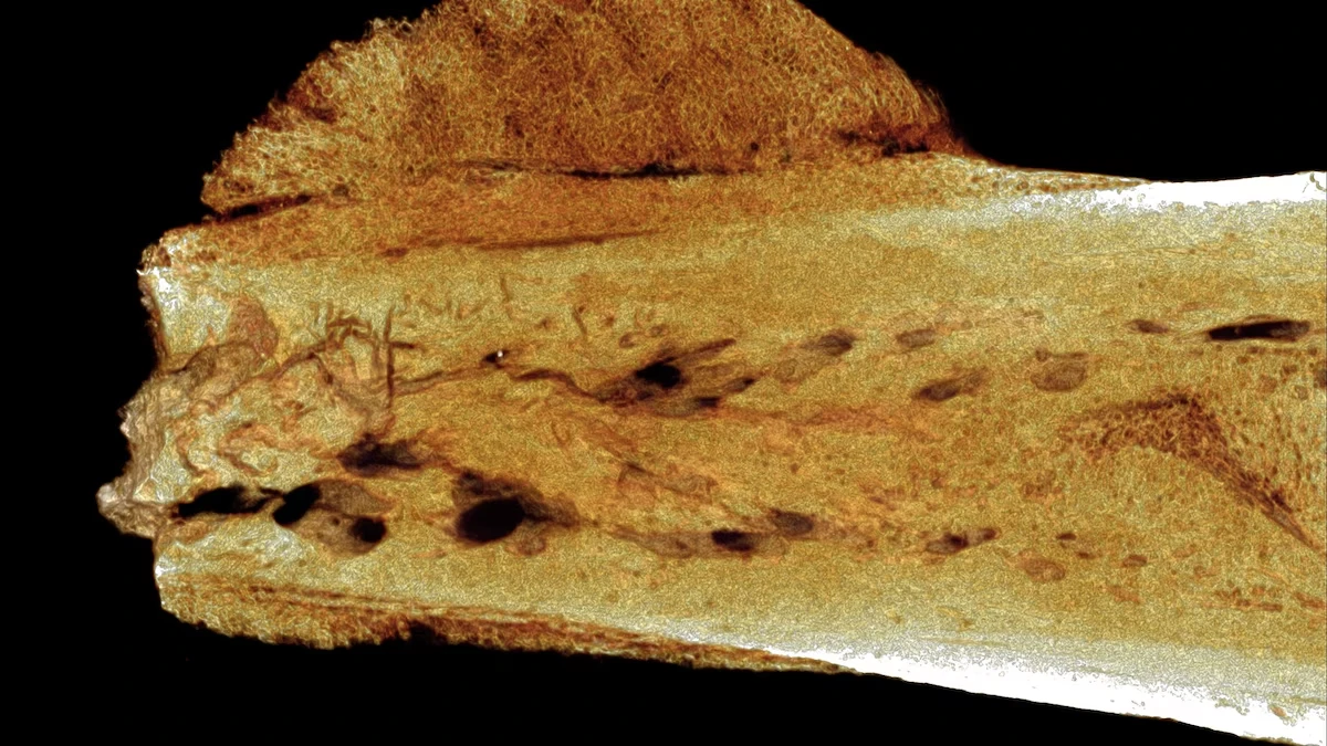 Giải mã ca ung thư cổ xưa nhất ở người