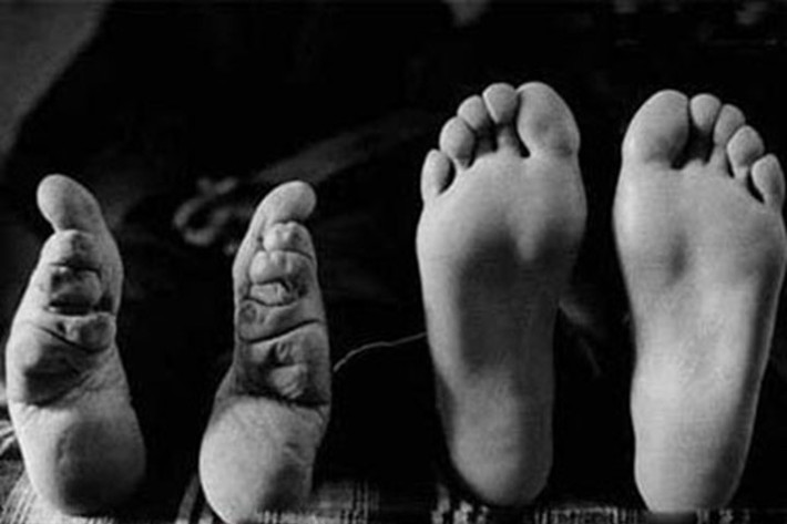Bó chân là một tập tục của người Trung Quốc cổ để có "gót sen ba thốn". Theo quan niệm của người Trung Quốc xưa, phụ nữ đẹp phải là người phụ nữ có bàn chân nhỏ. Chính vì vậy, các bé gái ngay từ nhỏ đã bị bố mẹ bắt phải bó chân và khiến bàn chân bị biến dạng.