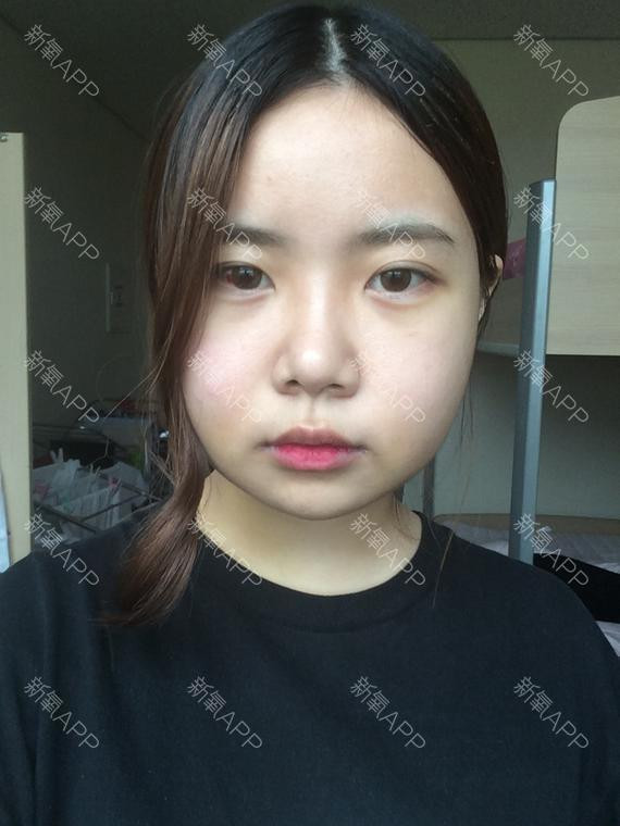 Đến ngày thứ 9, mặt cô nóng bừng lên nhưng có vẻ bớt đau đớn hơn.