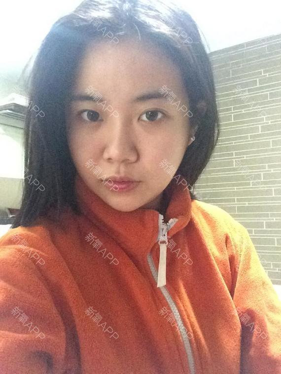 45 ngày sau khi phẫu thuật thẩm mỹ, cằm của cô đã thon gọn hơn sau khi má bớt sưng. Giờ đây, khuôn mặt của cô đã bắt đầu hình thành V-line.