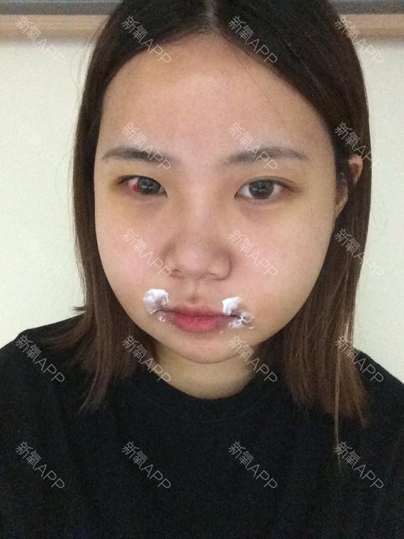 Bốn ngày sau khi phẫu thuật, khuôn mặt của cô vẫn sưng và đau nhức mỗi khi cử động.