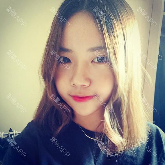 3 tháng sau phẫu thuật, cô trở nên xinh đẹp hơn hẳn với khuôn mặt thanh tú. Tuy nhiên, phần xương gò má vẫn chưa thực sự đẹp.