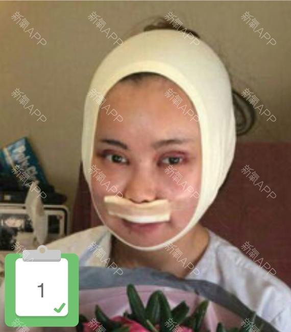 Xiaomeimei đã có sự khởi đầu với việc cắt mí và làm môi.