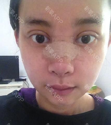 Khi các dấu vết dao kéo dần phai nhạt cũng là lúc vẻ xinh xắn của Xiaomeimei bắt đầu lộ ra.
