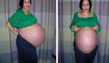 Nadya Gutierrez được biết đến là "bà mẹ sinh nhiều con nhất trong chỉ trong một lần lâm bồn". Cô trở thành tâm điểm của báo giới vào tháng 1/2009 khi hạ sinh cùng lúc 8 đứa con. Tất nhiên, sau khi chào đời, cả tám em bé phải được chăm sóc trong lồng kính vì trọng lượng quá nhẹ.