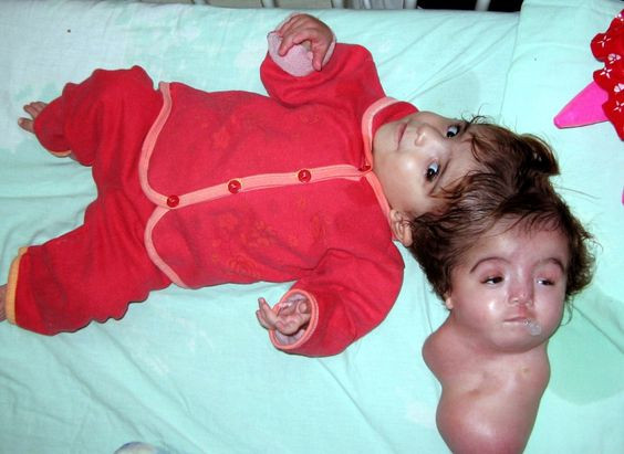 Manar Maged được sinh ra tại 1 bệnh viện của Ai Cập vào tháng 3 năm 2004 và ngay sau khi sinh, Manar đã trở thành trung tâm chú ý của giới truyền thông trong và ngoài Ai Cập. Lý do là Manar có 1 cơ thể vô cùng đặc biệt với 1 cơ thể bình thường và 2 đầu dính với nhau.