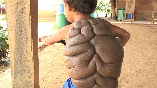 Cậu bé Didier Montalvo, 6 tuổi bị mắc một chứng bệnh hiếm gặp có tên gọi là Congenital Melanocytic Nevus nên được gọi là “người rùa” bởi những khối u khổng lồ phía sau lưng cậu bé trông như một "chiếc mai rùa".