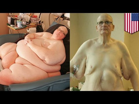 Paul Manson với làn da "nhão nhoét" sau khi tạm biệt cơ thể xồ xề.