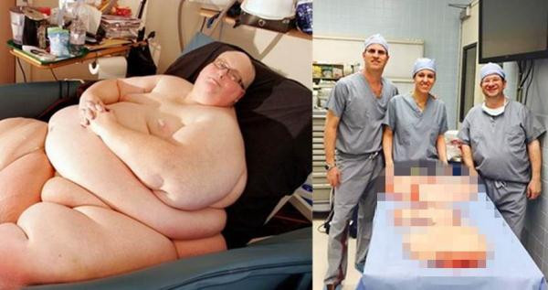 Ví dụ như Paul Manson, 54 tuổi đến từ nước Anh. Ông đã giảm hơn 140 cân trong vòng 5 năm, sau đó tiến hành phẫu thuật cắt bỏ hơn 20 cân phần da thừa.