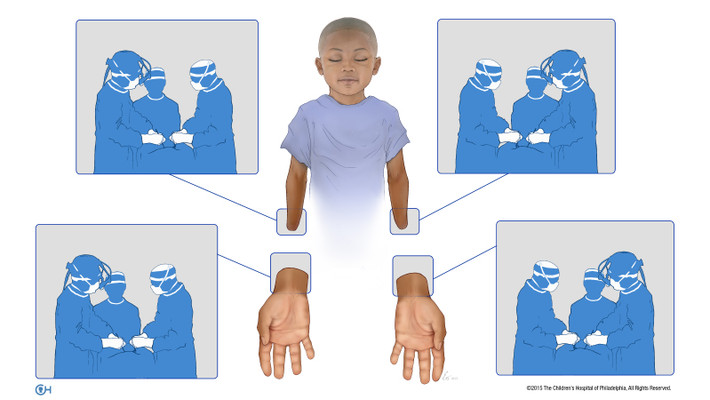 Nhờ ca ghép thận năm 4 tuổi cùng các loại thuốc miễn dịch, Zion trở thành ứng viên lý tưởng cho ca ghép hai tay. Đây là ca ghép tay đầu tiên trong lịch sử và Zion nghiễm nhiên trở thành cậu bé đầu tiên được ghép hai tay.