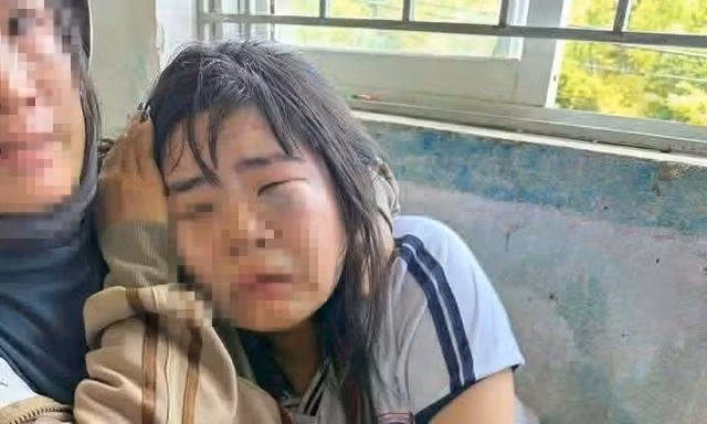 Em D.T.K (học sinh lớp 7A, Trường THCS Bình Thuận) bị bạn đánh sưng húp mặt, mắt bầm tím